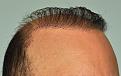 Click image for larger version

Name:	multiple-on-hairline-2.jpg
Views:	489
Size:	95.3 KB
ID:	437237