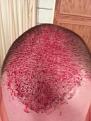 Click image for larger version

Name:	derma5.jpg
Views:	750
Size:	89.1 KB
ID:	437340