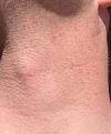 Click image for larger version

Name:	left neck post 45 days donor.jpg
Views:	462
Size:	91.5 KB
ID:	438321