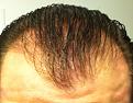 Click image for larger version

Name:	6-24 pre-op1.jpg
Views:	381
Size:	85.6 KB
ID:	438775