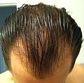 Click image for larger version

Name:	6-24 pre-op2.jpg
Views:	388
Size:	88.5 KB
ID:	438776