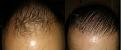 Click image for larger version

Name:	1 Year - Hairline Before &amp;amp; After.jpg
Views:	311
Size:	17.2 KB
ID:	438885