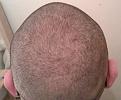 Click image for larger version

Name:	back of scalp.jpg
Views:	764
Size:	92.3 KB
ID:	439086