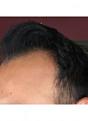 Click image for larger version

Name:	2 months pre op.jpg
Views:	823
Size:	5.5 KB
ID:	439171