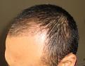 Click image for larger version

Name:	1 month post op left side.jpg
Views:	1239
Size:	13.5 KB
ID:	439173