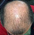 Click image for larger version

Name:	25th day after surgery-2.jpg
Views:	479
Size:	96.8 KB
ID:	439469