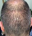 Click image for larger version

Name:	25th day after surgery-3.jpg
Views:	505
Size:	99.1 KB
ID:	439470