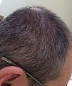 Click image for larger version

Name:	25th day after surgery-4.jpg
Views:	539
Size:	96.9 KB
ID:	439471