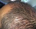 Click image for larger version

Name:	25th day after surgery-5.jpg
Views:	561
Size:	98.8 KB
ID:	439472
