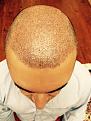 Click image for larger version

Name:	Pic2-2days post Surgery.jpg
Views:	435
Size:	89.9 KB
ID:	439473