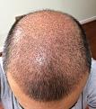 Click image for larger version

Name:	13th day after surgery-1.jpg
Views:	559
Size:	95.2 KB
ID:	439484