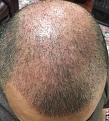Click image for larger version

Name:	5weeks after surgery-1.jpg
Views:	566
Size:	95.7 KB
ID:	439514