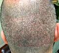 Click image for larger version

Name:	5weeks after surgery-2.jpg
Views:	517
Size:	98.8 KB
ID:	439515