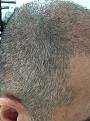 Click image for larger version

Name:	5weeks after surgery-3.jpg
Views:	508
Size:	97.2 KB
ID:	439516