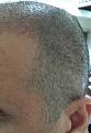 Click image for larger version

Name:	5weeks after surgery-4.jpg
Views:	518
Size:	93.4 KB
ID:	439517