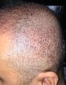 Click image for larger version

Name:	5weeks after surgery-5.jpg
Views:	523
Size:	98.4 KB
ID:	439518