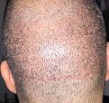 Click image for larger version

Name:	5weeks after surgery-6.jpg
Views:	561
Size:	98.5 KB
ID:	439519