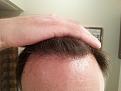 Click image for larger version

Name:	Front hairline 6 months.jpg
Views:	332
Size:	91.6 KB
ID:	440455