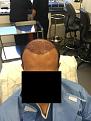 Click image for larger version

Name:	4-2015 Post-op Day 0.jpg
Views:	860
Size:	89.5 KB
ID:	440837