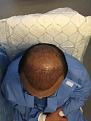 Click image for larger version

Name:	5-2015 Post-op Day 0.jpg
Views:	854
Size:	87.1 KB
ID:	440838