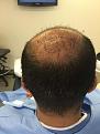 Click image for larger version

Name:	6-2015 Post-op Day 0.jpg
Views:	790
Size:	93.3 KB
ID:	440839