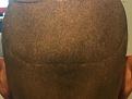 Click image for larger version

Name:	100 - Scar Post-op Month11.5.jpg
Views:	857
Size:	87.4 KB
ID:	440845
