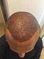 Click image for larger version

Name:	1 Post-op Day 1.jpg
Views:	855
Size:	91.8 KB
ID:	440846