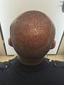 Click image for larger version

Name:	3 Post-op Day 1.jpg
Views:	790
Size:	90.9 KB
ID:	440847