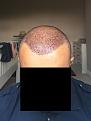 Click image for larger version

Name:	4 Post-op Day 1.jpg
Views:	764
Size:	90.1 KB
ID:	440848