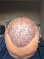 Click image for larger version

Name:	5 Post-op Day 1.jpg
Views:	850
Size:	93.3 KB
ID:	440849