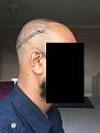 Click image for larger version

Name:	6 Post-op Day 1.jpg
Views:	796
Size:	90.4 KB
ID:	440850