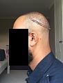 Click image for larger version

Name:	7 Post-op Day 1.jpg
Views:	806
Size:	90.5 KB
ID:	440851
