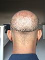 Click image for larger version

Name:	8 Post-op Day 1.jpg
Views:	1057
Size:	93.9 KB
ID:	440852