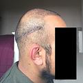 Click image for larger version

Name:	10 Post-op Day 8.jpg
Views:	782
Size:	90.7 KB
ID:	440873