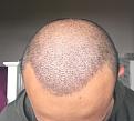 Click image for larger version

Name:	10 Post-op Day 8.jpg
Views:	867
Size:	92.2 KB
ID:	440874