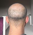 Click image for larger version

Name:	12 Post-op Day 8.jpg
Views:	914
Size:	93.6 KB
ID:	440875