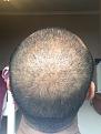 Click image for larger version

Name:	14 Post-op Day 15.jpg
Views:	725
Size:	95.5 KB
ID:	440876