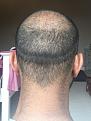 Click image for larger version

Name:	15 Post-op Day 15.jpg
Views:	907
Size:	95.8 KB
ID:	440877