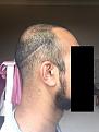 Click image for larger version

Name:	11 Post-op Day 15.jpg
Views:	935
Size:	90.1 KB
ID:	440878