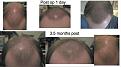 Click image for larger version

Name:	Hair Transplant.jpg
Views:	363
Size:	18.9 KB
ID:	440960