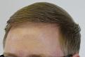 Click image for larger version

Name:	12 months post-op1.jpg
Views:	425
Size:	87.1 KB
ID:	441743