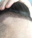 Click image for larger version

Name:	10 Days Post Op 3.jpg
Views:	555
Size:	64.6 KB
ID:	442507