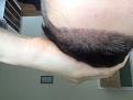 Click image for larger version

Name:	10 Days Post Op 4.jpg
Views:	410
Size:	65.2 KB
ID:	442508