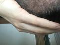 Click image for larger version

Name:	10 Days Post Op 5.jpg
Views:	389
Size:	82.9 KB
ID:	442509