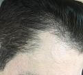 Click image for larger version

Name:	3 Months Post Op 2.jpg
Views:	448
Size:	95.1 KB
ID:	442512