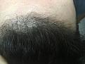 Click image for larger version

Name:	3 Months Post Op 4.jpg
Views:	382
Size:	92.5 KB
ID:	442514