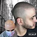 Click image for larger version

Name:	Scalp Micropigmentation Toronto Touch up.jpg
Views:	244
Size:	94.6 KB
ID:	445301