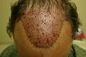 Click image for larger version

Name:	b sm immediately post op.jpg
Views:	1004
Size:	44.6 KB
ID:	445796