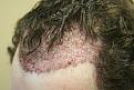 Click image for larger version

Name:	b immed post op.jpg
Views:	650
Size:	57.8 KB
ID:	445871