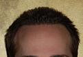 Click image for larger version

Name:	d PA 6mn post-op.jpg
Views:	815
Size:	21.8 KB
ID:	445914